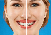 Clear braces vs Metal braces